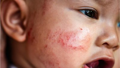 Pioneering Study Suggests Vaccines Could End Eczema’s Itch for Good