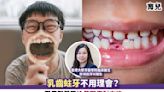 育兒｜乳齒蛀牙不用理會？跟牙醫學習換牙期應對方法