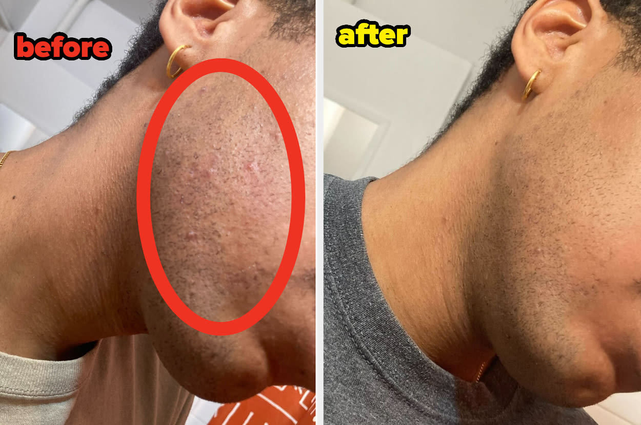 I Haven't Clean-Shaven My Face In Three Years Because I've Struggled With Ingrown Hairs, So I Tried This Hair Tonic...