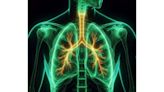 Research shows that ferroptosis, a form of cell death, occurs in severe COVID-19 patient lungs