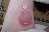 Erythema annulare centrifugum