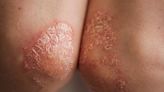 Air pollution exposure tied to new psoriasis