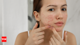 Acne and pimples? Dietary rules to not break in case of acne - Times of India