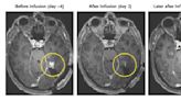 A new strategy to attack aggressive brain cancer shrank tumors in two early tests