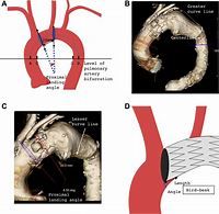 Image courtesy of annalsofvascularsurgery.com