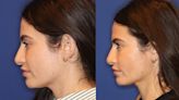 Ultherapy Is the Only Treatment I've Tried That Visibly Changed My Face