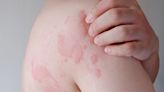 「蕁麻疹」怎麼止癢？症狀為何？皮膚科醫師教你3種舒緩方式、止癢飲食技巧