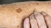 Lentigo (Liver Spots)