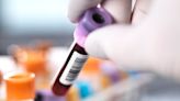 Liquid Biopsy Shows Promise in Detecting Pancreatic Cancer