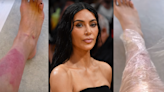 Kim Kardashian Revealed Photos of Her Latest Psoriasis Flare-Up Following Tanning Bed Backlash
