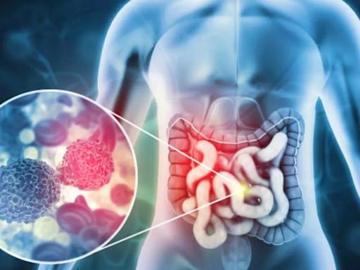 Bloody Stool: Is It A Sign of Colon Cancer? Know Other Symptoms