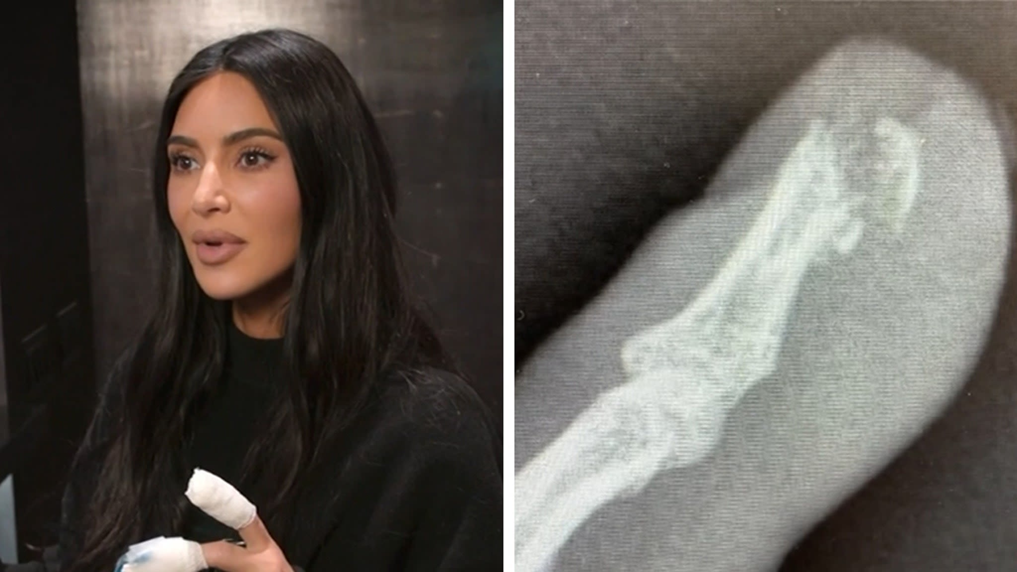 Kim Kardashian Shows Gory Injury, Fingertip Sliced Off, Bone Exposed