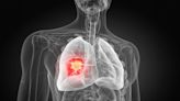 Mutation Mystery Solved: Why Lung Cancer Treatments Often Fail in Non-Smokers