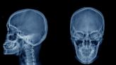 When you get a concussion, your skull may get thicker and we're not sure why