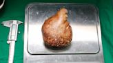 Doctors remove "world's largest kidney stone" from retired soldier