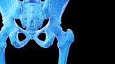 Hip Joint Dysfunction in Runners: Causes, Solutions, and a Return to Pain-Free Movement
