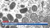 Duval County Health Department confirms two cases of Monkeypox in Jacksonville