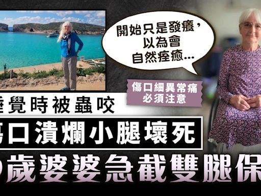 小傷口變大病｜疑睡覺時被蟲咬 傷口潰爛小腿壞死 69歲婆婆急截雙腿保命