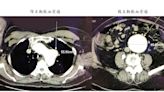 劇烈背痛後昏厥急送醫 竟是兩顆「不定時炸彈」血管瘤藏體內