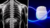 Medtronic obtuvo la aprobación en Estados Unidos para un implante ajustable para el dolor de columna