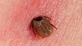 Identifying a Tick Bite From Pictures