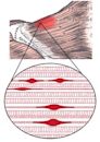 Myofascial trigger point