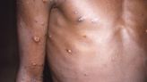 Monkeypox reported in 26 states. Here’s info on vaccine side effects and who should consider getting the shot