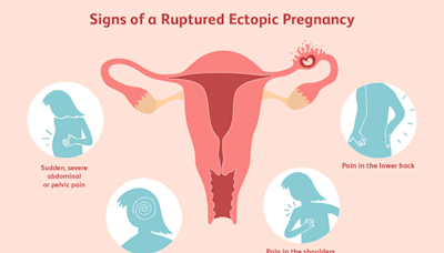 What To Know About Ruptured Ectopic Pregnancy