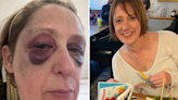 Gran battered black & blue by feral gang who stamped on her head as she slept