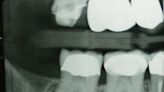 El TEPT triplica las probabilidades de rechinar los dientes, según un estudio