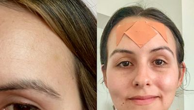 I tried both Botox and face tape for my forehead lines. Neither is perfect, but one feels better in the long run.