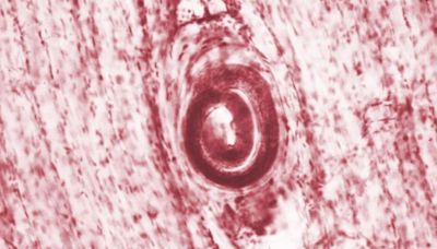 Parasitic worms infect 6 after bear meat served at family reunion