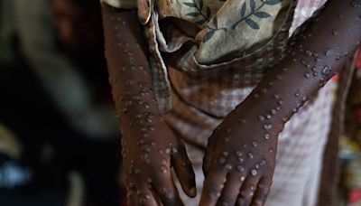 What we know about the mpox outbreak