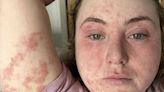 UK Woman Develops Severe 'Elephant Skin' Rash for 10 Months After Allergic Reaction to Dental Veneers