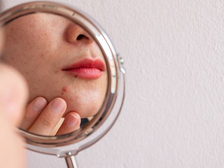 油痘肌不是天生的？皮膚科醫師公開「改善油痘膚質」成功5祕訣：洗面乳首選「這成分」減少刺激