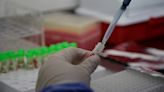 Colombia duplica sus casos de viruela del mono y ya acumula 273