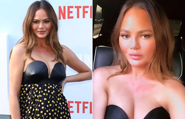 Chrissy Teigen Shares Clip of Her 'Anxiety Hives' Ahead of Red Carpet Appearance: 'Every Event'