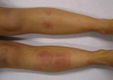 Erythema nodosum