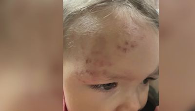 Mom says her 1-year-old daughter was bitten twice at daycare