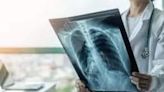 Burden of lung diseases in India likely much higher than Lancet study's projection: Doctors - ET HealthWorld