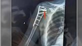手臂骨折打鋼板 女3年後驚「鑽頭留在骨頭裡」…醫：繼續放著更安全