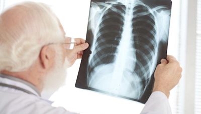 Inteligencia Artificial para interpretar radiografías en el Hospital de Lugo