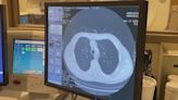 SSM Health Medical Minute: Lung cancer screening as critical as mammogram, colonoscopy