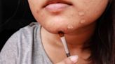 ‘Adult-onset acne’ more common than you think