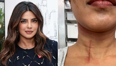 Priyanka Chopra Shares Image of Neck Cut Suffered Doing Stunts on New Movie: ‘Hazards on My Jobs’