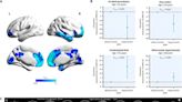 High BMI linked to reduced brain volume and increased white matter lesions