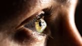 Keratoconus in One Eye: Why Does it Happen?