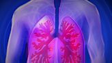 EU approves Sanofi drug for chronic lung disease