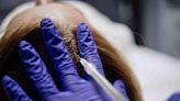 Platelet-Rich Plasma (PRP) Injections for Hair Loss: What to Know Beforehand