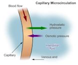 Hypovolemic shock